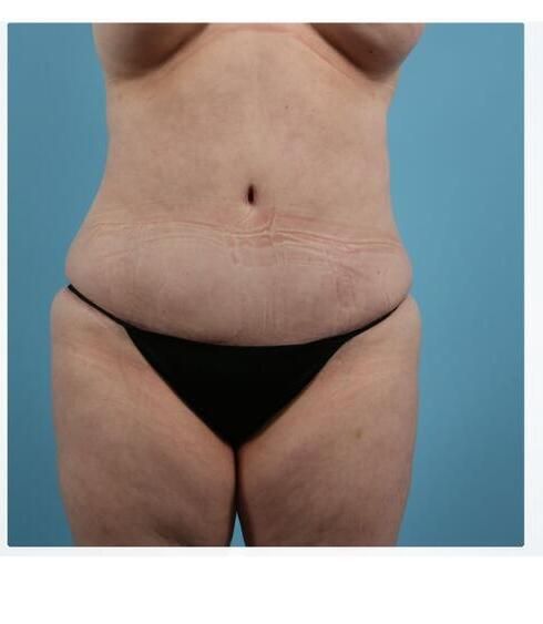 Abdominoplasty Before & After