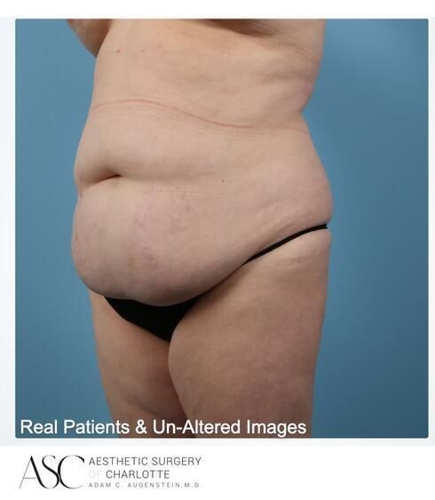 Abdominoplasty Before & After