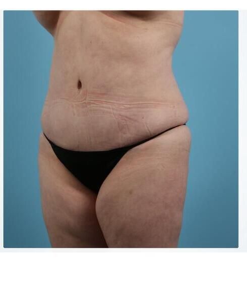 Abdominoplasty Before & After