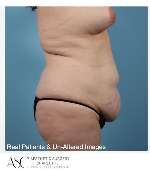 Abdominoplasty Before & After