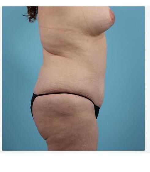 Abdominoplasty Before & After
