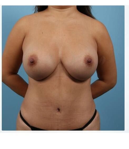 Abdominoplasty Before & After