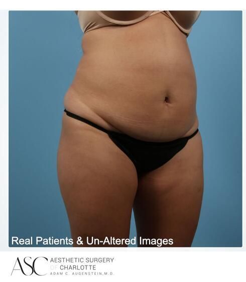 Abdominoplasty Before & After
