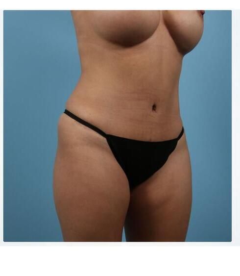 Abdominoplasty Before & After