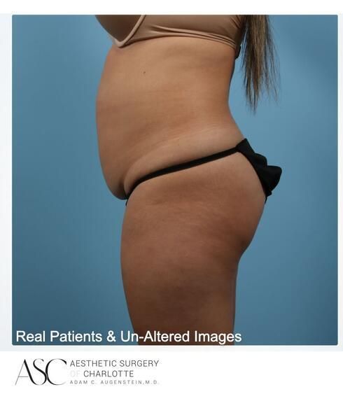 Abdominoplasty Before & After