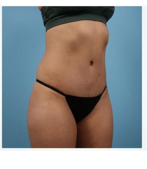 Abdominoplasty Before & After