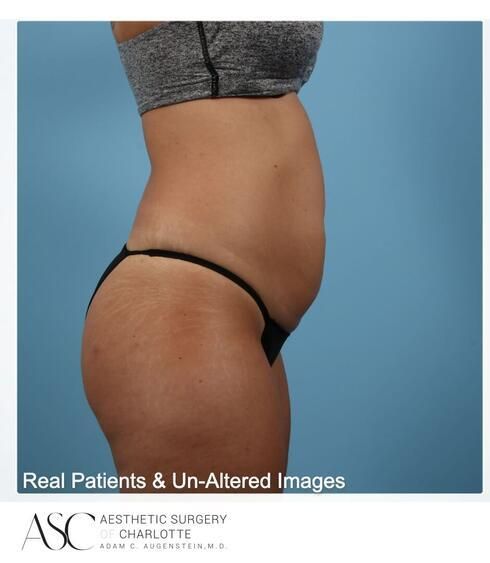 Abdominoplasty Before & After