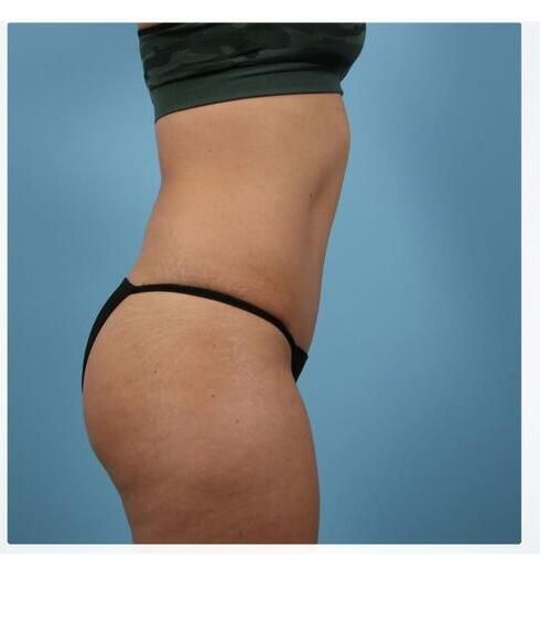 Abdominoplasty Before & After