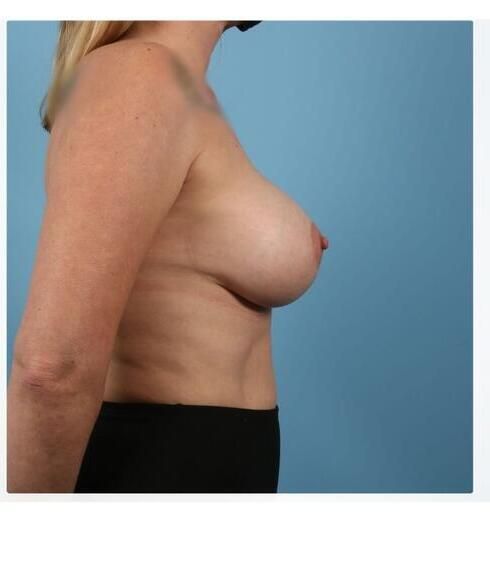 Abdominoplasty Before & After