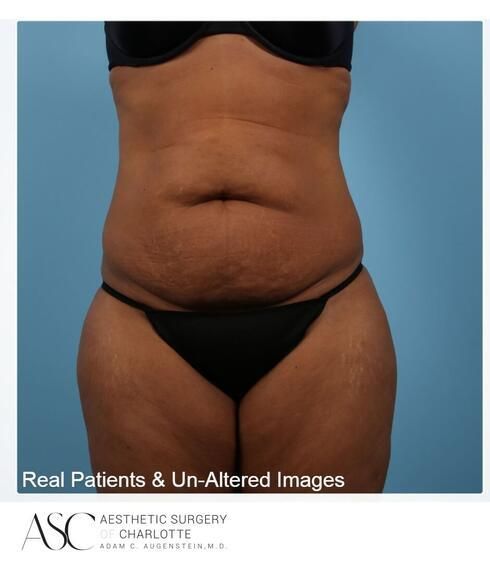 Abdominoplasty Before & After