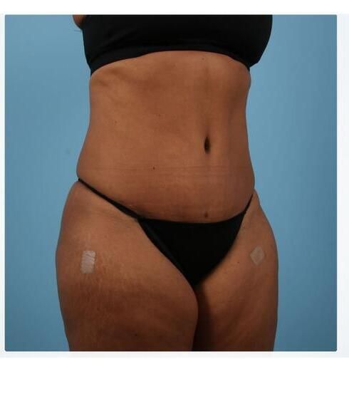 Abdominoplasty Before & After