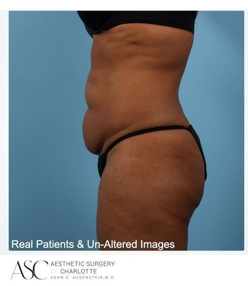 Abdominoplasty Before & After