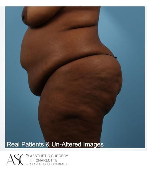 Abdominoplasty Before & After