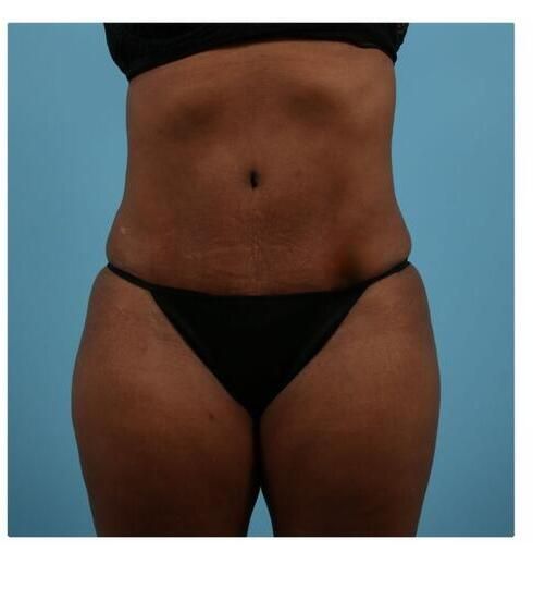 Abdominoplasty Before & After