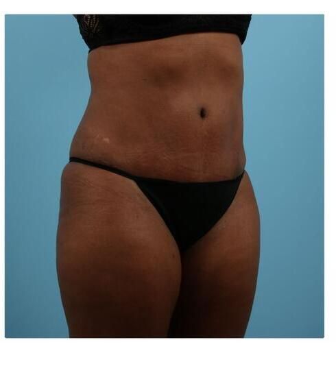 Abdominoplasty Before & After