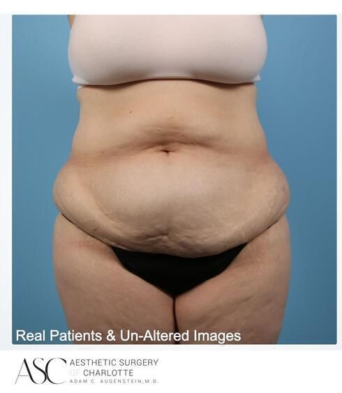 Abdominoplasty Before & After