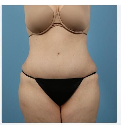 Abdominoplasty Before & After