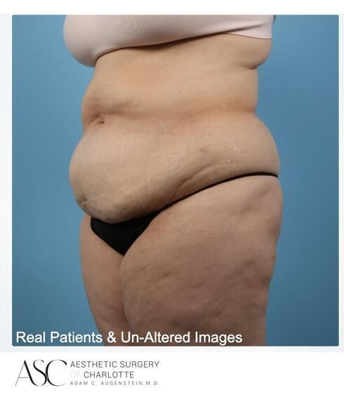 Abdominoplasty Before & After