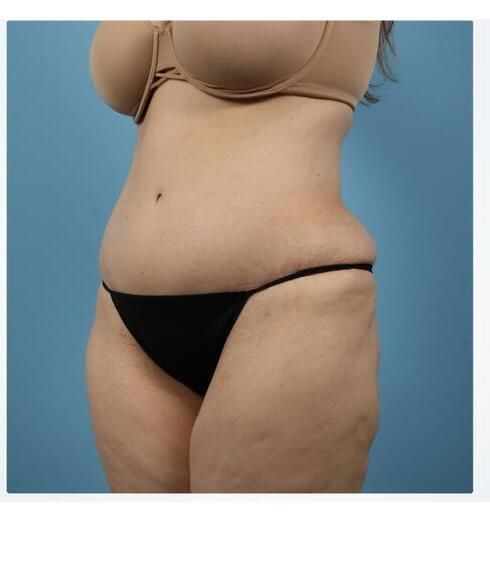 Abdominoplasty Before & After