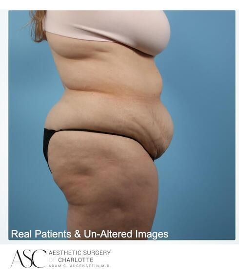 Abdominoplasty Before & After