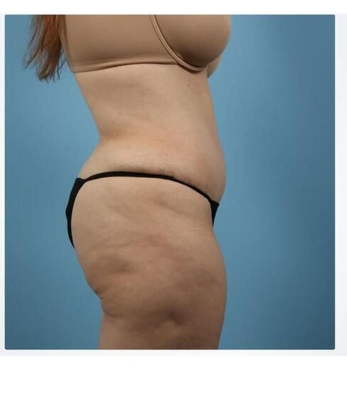 Abdominoplasty Before & After
