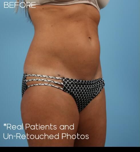 Abdominoplasty Before & After