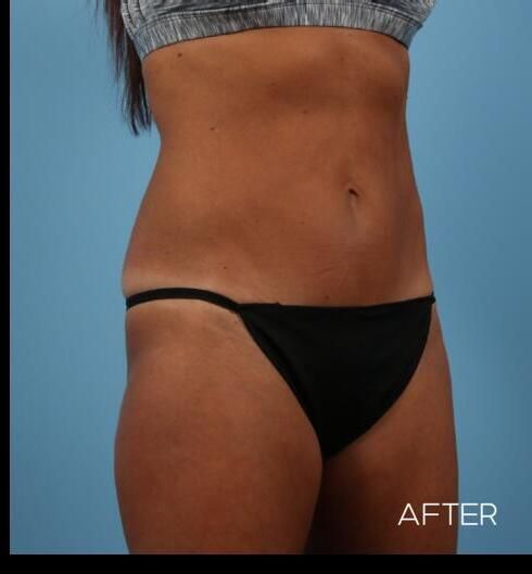 Abdominoplasty Before & After