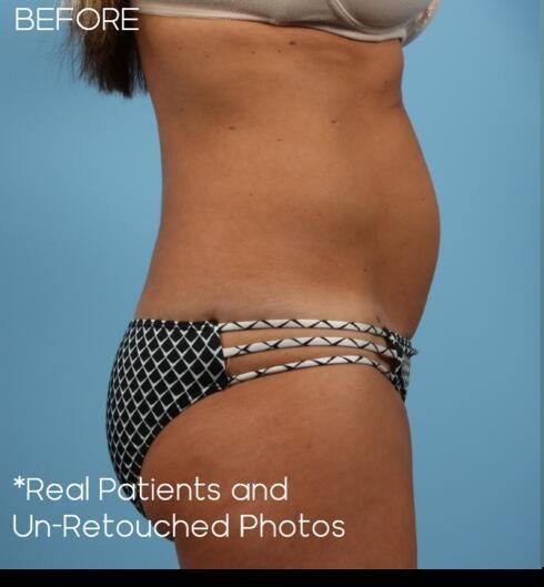 Abdominoplasty Before & After