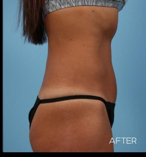 Abdominoplasty Before & After