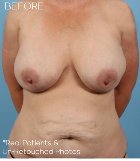 Abdominoplasty Before & After