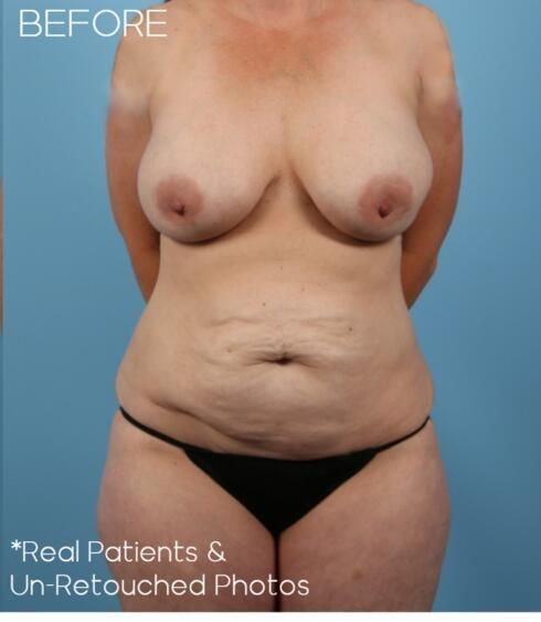 Abdominoplasty Before & After