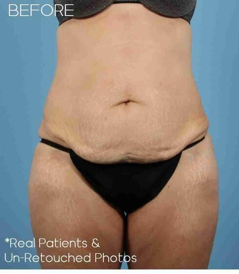Abdominoplasty Before & After