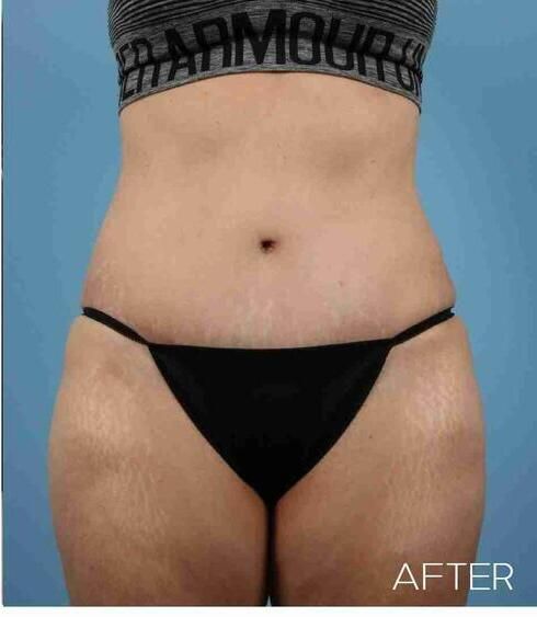 Abdominoplasty Before & After