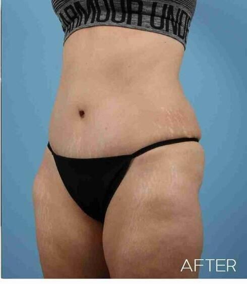 Abdominoplasty Before & After
