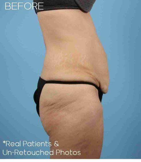 Abdominoplasty Before & After