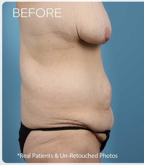 Abdominoplasty Before & After