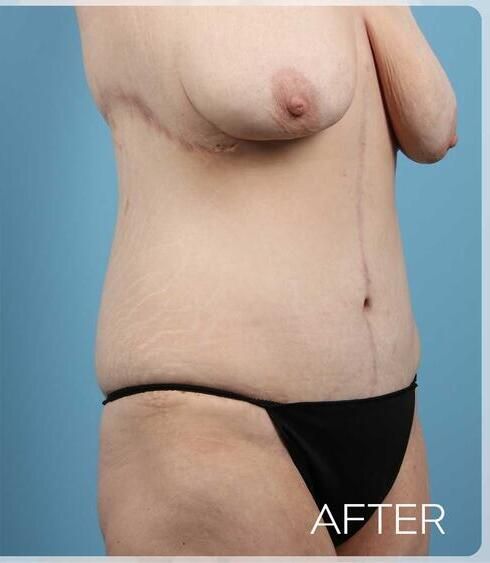 Abdominoplasty Before & After