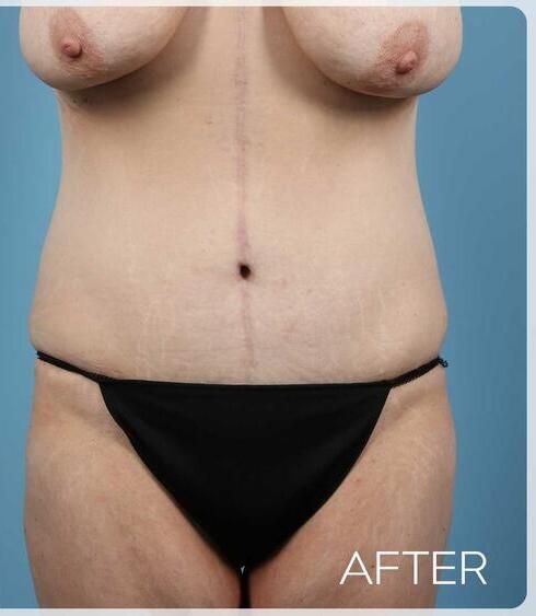Abdominoplasty Before & After