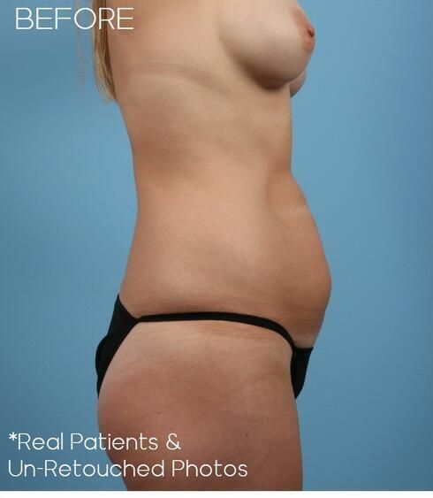 Abdominoplasty Before & After