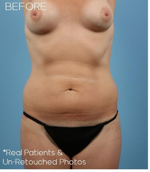 Abdominoplasty Before & After