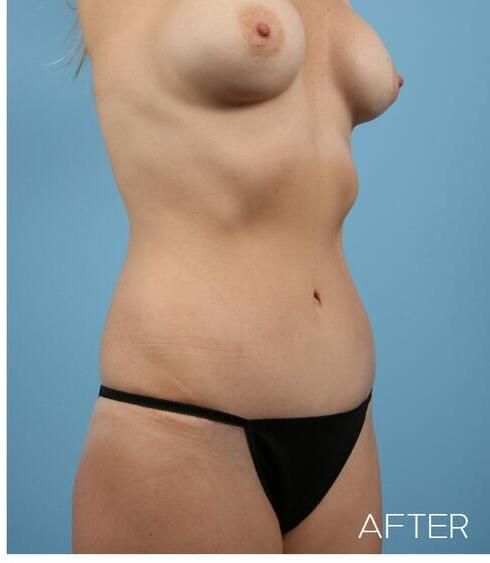 Abdominoplasty Before & After