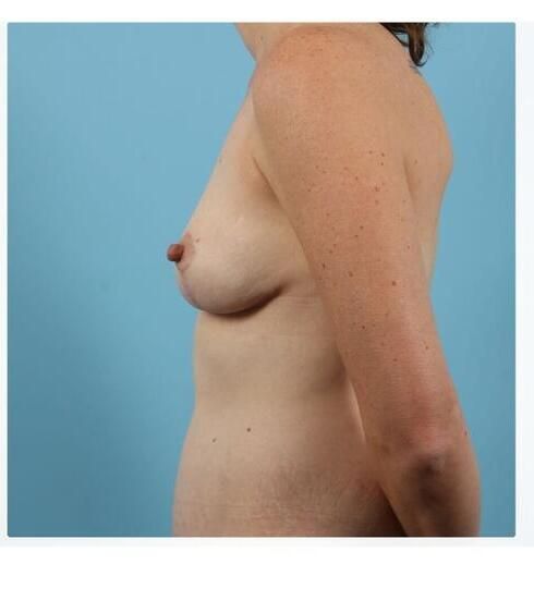 Abdominoplasty Before & After