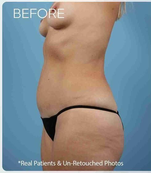 Abdominoplasty Before & After