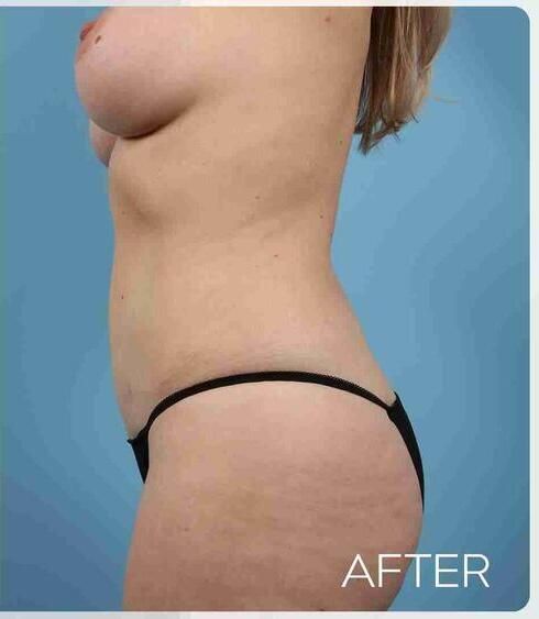 Abdominoplasty Before & After