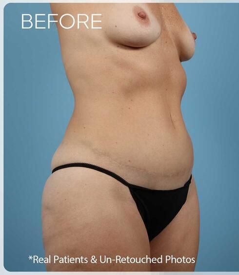 Abdominoplasty Before & After