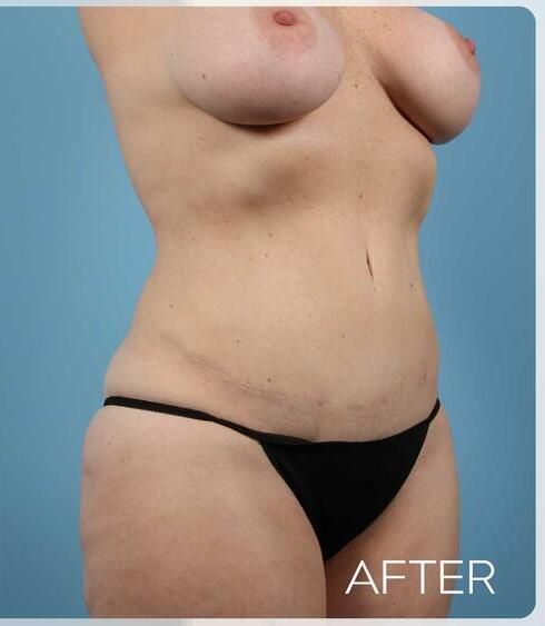 Abdominoplasty Before & After