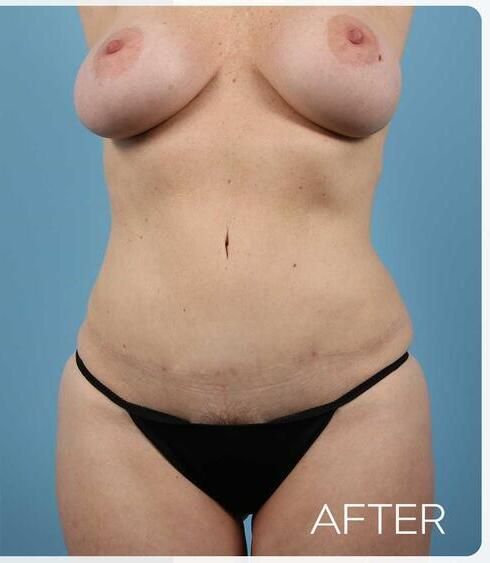 Abdominoplasty Before & After