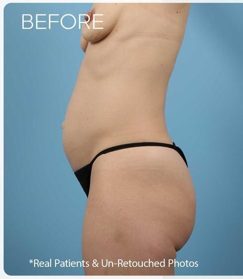 Abdominoplasty Before & After