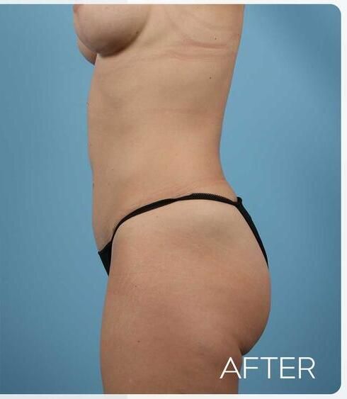 Abdominoplasty Before & After