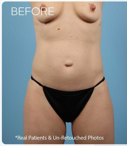 Abdominoplasty Before & After